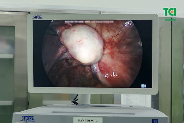 Khối u lớn dần, gây chèn ép và làm ảnh hưởng đến chức năng, hoạt động của các cơ quan lân cận và sức khỏe của chị em