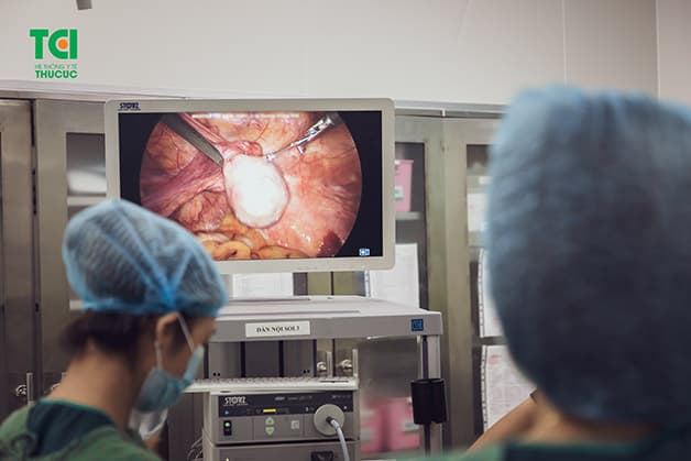 Một trường hợp bệnh nhân được thực hiện phẫu thuật mổ nội soi u xơ tử cung đa nhân