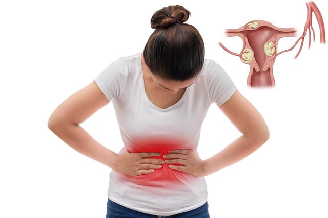 Tình trạng u xơ tử cung đau bụng dưới, chị em nhớ cảnh giác!