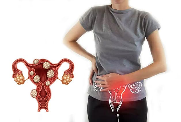 U xơ tử cung có thể xuất hiện ở nhiều vị trí, gây ra những triệu chứng khó chịu cho người bệnh
