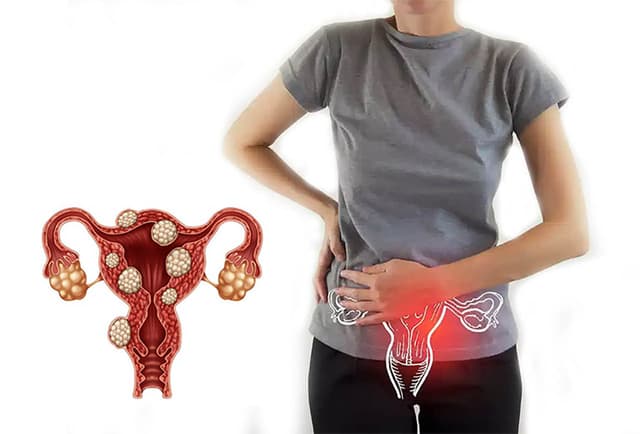 U xơ tử cung gây đau lưng liệu có nguy hiểm với chị em?