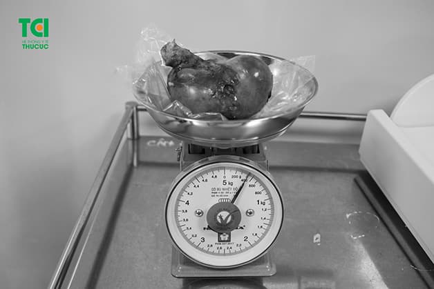 Có những trường hợp khối u đã phát triển nhiều năm và có kích thước rất lớn, gây chèn ép lên các cơ quan lân cận