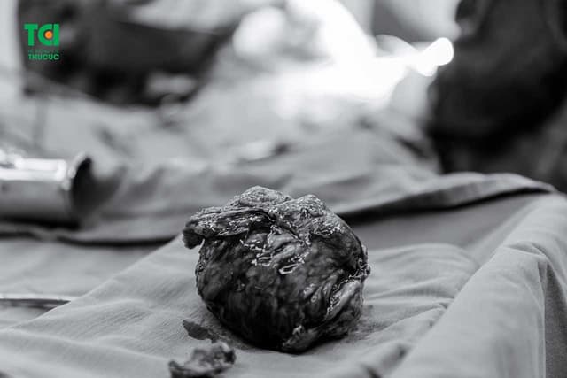 Có nên lo ngại về u xơ tử cung ở tuổi mãn kinh?