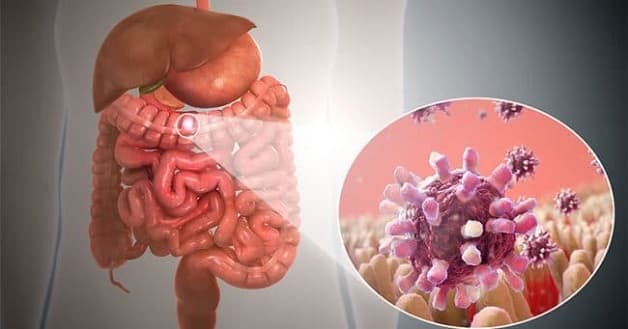 Viêm đại tràng vi thể