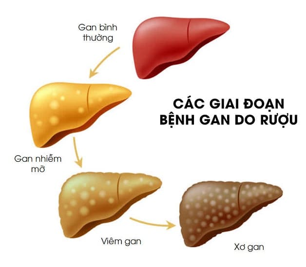 Giai đoạn viêm gan do rượu