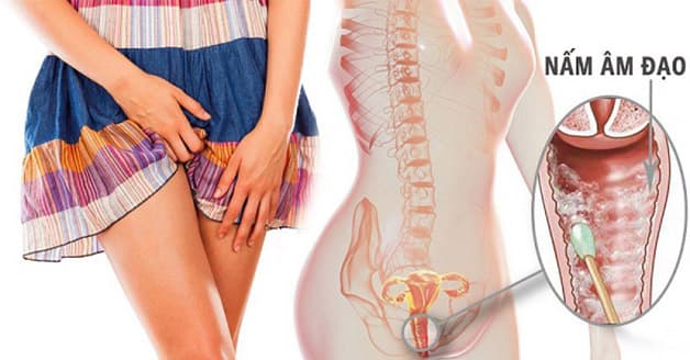 Có tới 95% phụ nữ từng bị viêm nấm phụ khoa một lần trong đời
