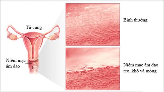 Viêm teo âm đạo là hiện tượng thường xảy ra ở phụ nữ thiếu hụt hormone estrogen, trong đó điển hình là phụ nữ tiền mãn kinh, mãn kinh