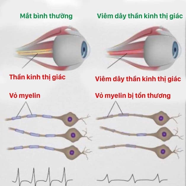 viêm thị thần kinh cấp