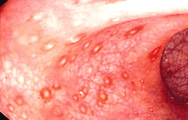 Viêm xuất huyết niêm mạc dạ dày là tình trạng khá phổ biến 