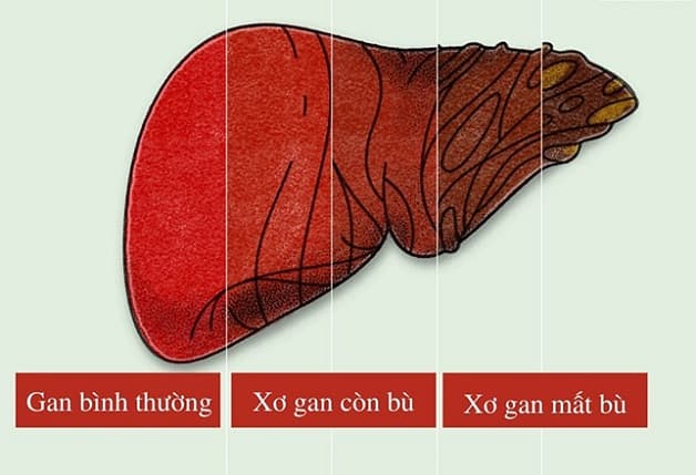 Xơ gan giai đoạn mất bù