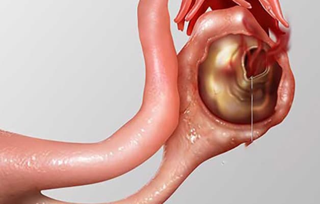 Hiện tượng xuất huyết nang buồng trứng là một trong những biến chứng nguy hiểm mà người bệnh cần chú ý