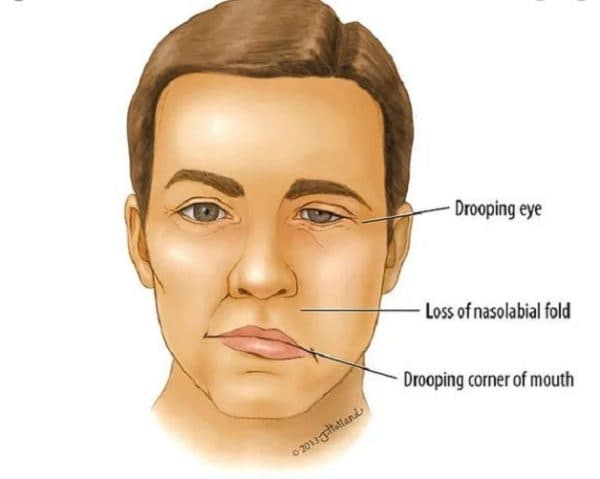 Viêm dây thần kinh sọ não ảnh hưởng nhiều đến khả năng vận động của người bệnh 