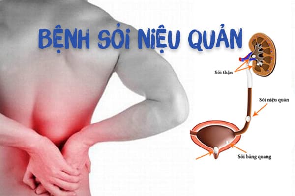 Phương pháp nội soi tán sỏi niệu quản