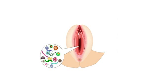 Âm đạo viêm do nhiều tác nhân và có thể diễn biến ngày càng nghiêm trọng hơn