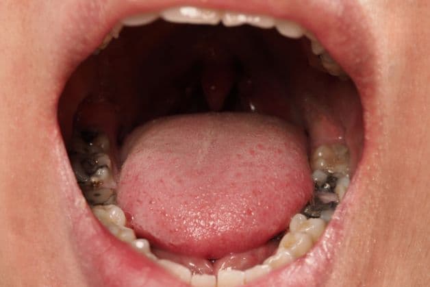 Nguyên nhân khiến bé bị viêm loét niêm mạc miệng.