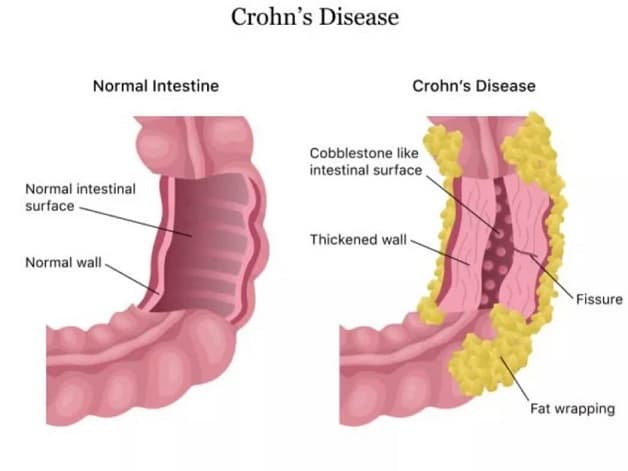 bệnh Crohn là gì