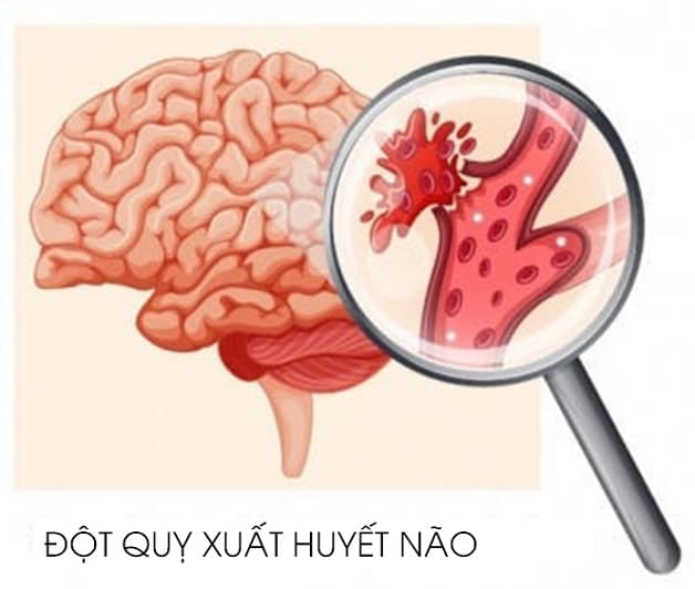 đột quỵ xuất huyết não