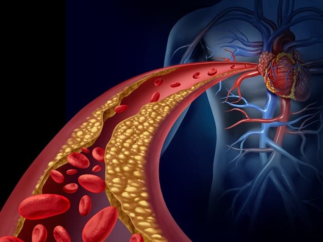 Bệnh lý mạch vành là gì?