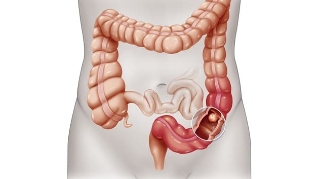 Bệnh polyp đại trực tràng là gì?