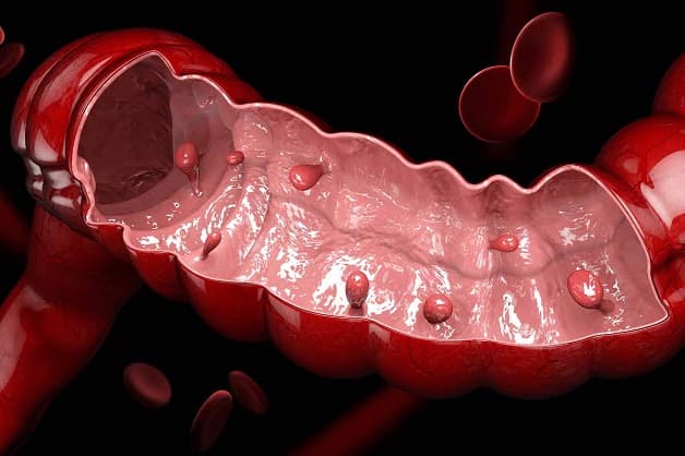 Chẩn đoán bệnh polyp đại trực tràng 