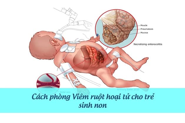 cách phòng bệnh viêm ruột hoại tử