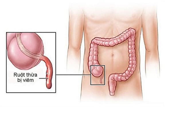 biểu hiện bệnh ruột thừa