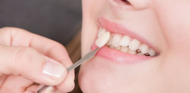 Tìm hiểu về bọc và dán sứ Veneer