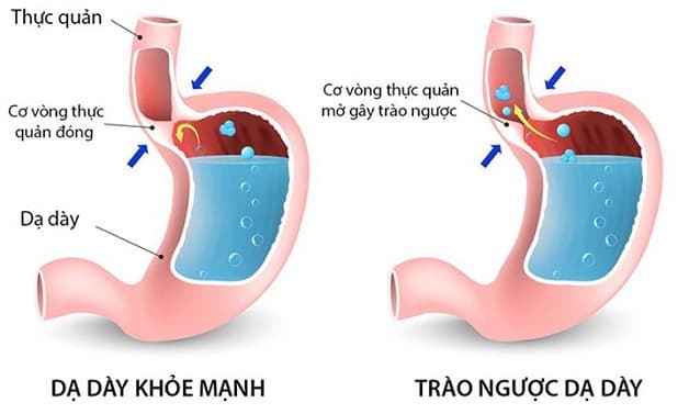 các cấp độ trào ngược dạ dày phân loại