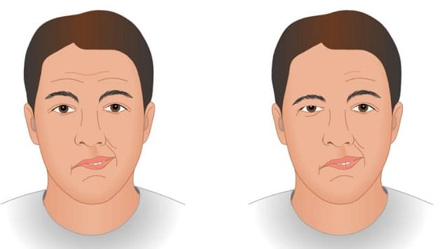 Triệu chứng nhồi máu não thường gặp