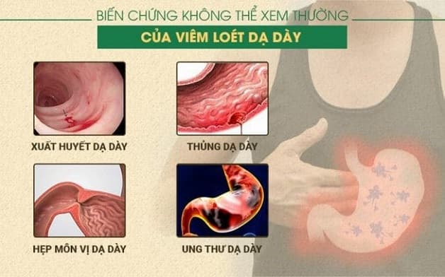 Viêm dạ dày tá tràng nếu không điều trị sớm có thể gây ra nhiều biến chứng nguy hiểm