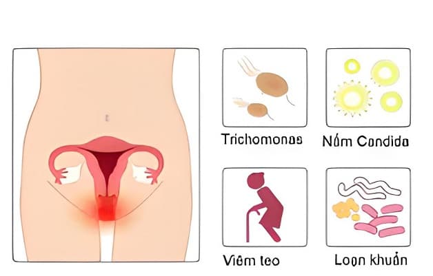 Viêm vùng kín xuất hiện do nhiều tác nhân gây bệnh khác nhau