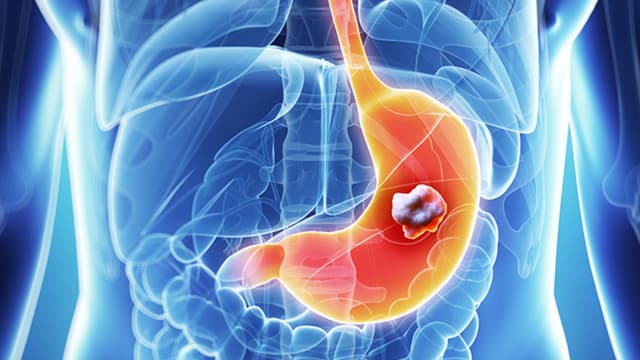 Cách nhận biết ung thư dạ dày sớm