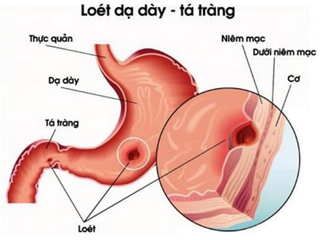 cách nhận biết viêm loét dạ dày