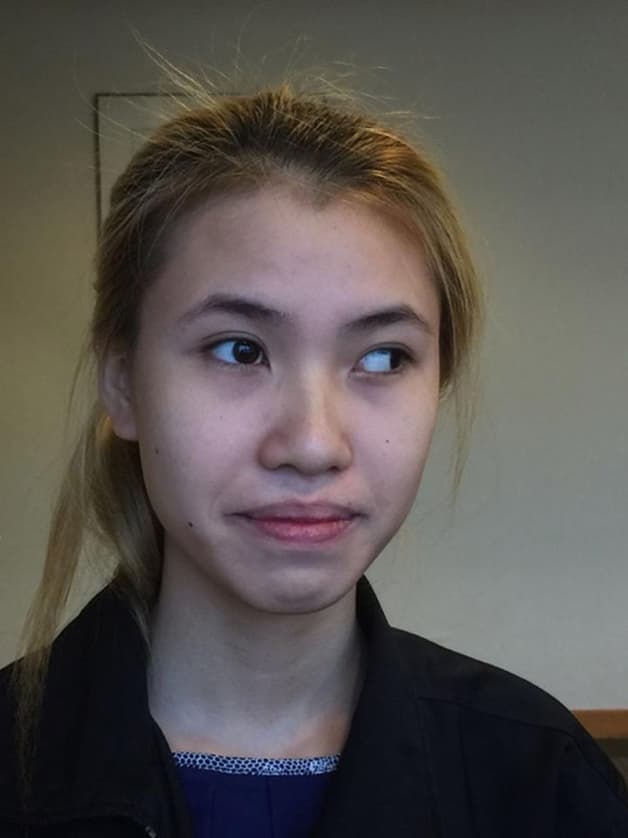 cách trị lé kim