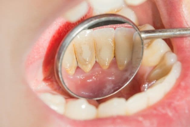 Tại sao cần chăm sóc răng sau khi cạo vôi?