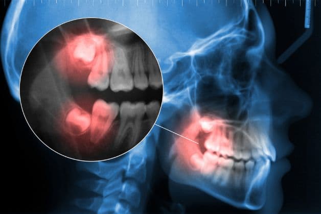 Những chú ý chăm sóc sau nhổ răng hàm.