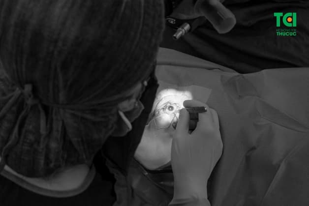 chi phí mổ đục thủy tinh thể