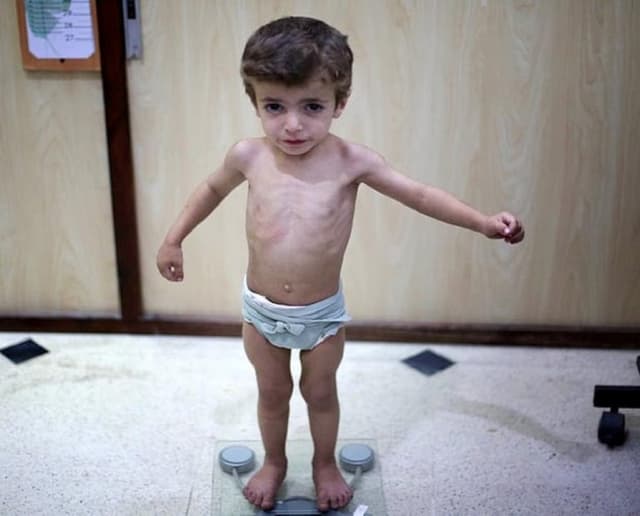 Cha mẹ chớ coi thường còi xương ở trẻ em