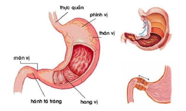 Viêm dạ dày hành tá tràng là bệnh lý phổ biến ở hệ tiêu hóa