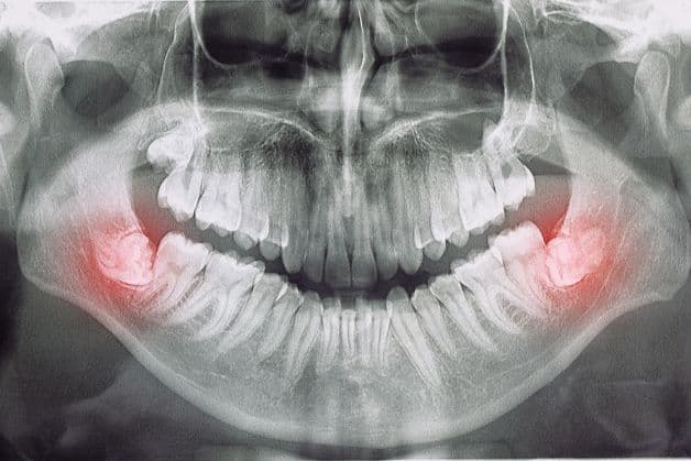 Mọc răng khôn gây đau chân răng. 