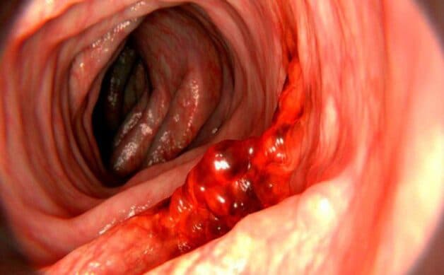 Xuất huyết tiêu hóa - biến chứng nguy hiểm do đau đại tràng không được điều trị