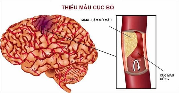 đau đầu vì thiếu ngủ lâu ngày do thiếu máu não