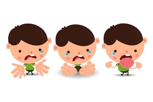 Dấu hiệu bị tay chân miệng ở trẻ thường thấy là sốt cao, phát ban, loét miệng