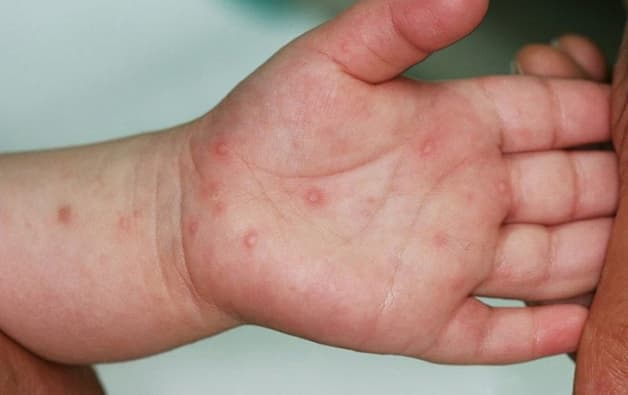 dấu hiệu tay chân miệng