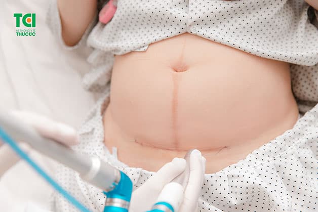 Quá trình lưu viện sau sinh, sản phụ được chăm sóc, kiểm tra vết mổ hàng ngày