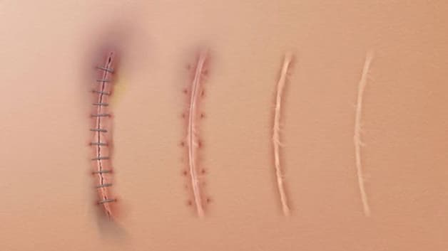 Chỉ tự tiêu được dùng nhiều trong phẫu thuật, trong đó có cả phẫu thuật Sản khoa