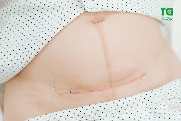 Trung bình từ 3 tháng sau sinh, vết mổ đẻ mới lành hẳn và lúc đó các mẹ mới có thể quan hệ trở lại mà không lo vết mổ bị bục, rách