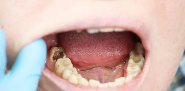 Những điều nên biết về sâu răng và điều trị răng sâu