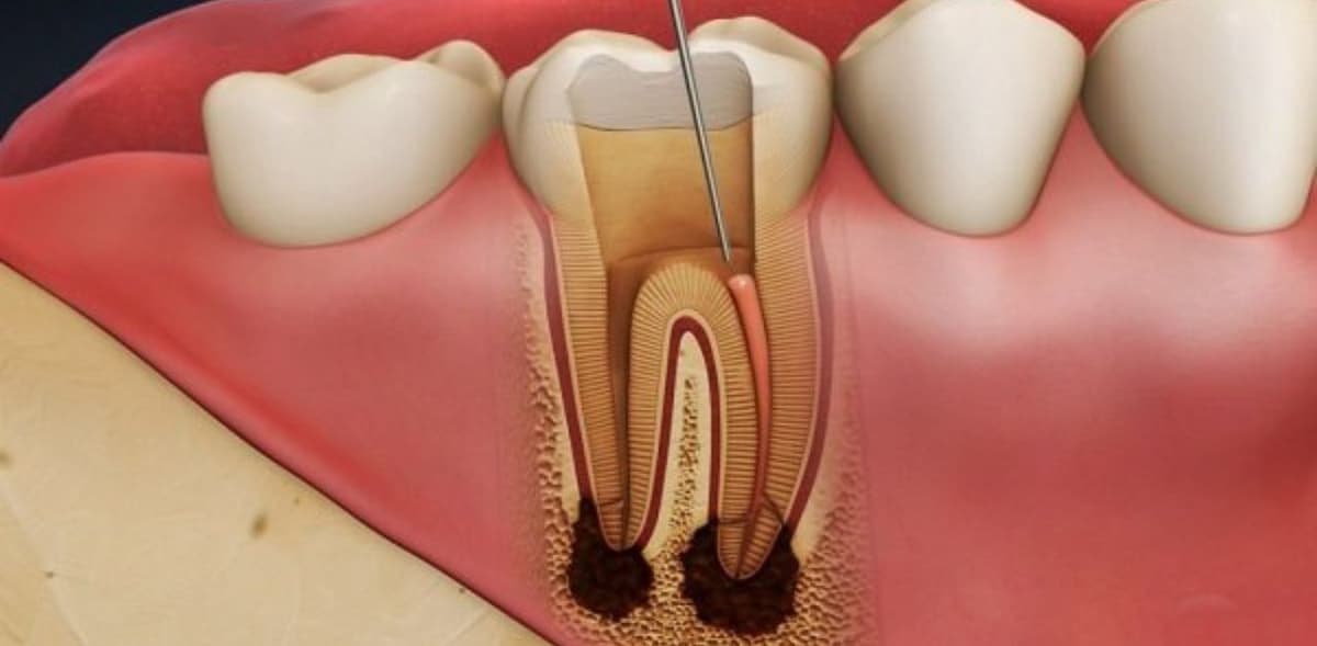 Điều trị tuỷ răng cho bé có nguy hiểm không?