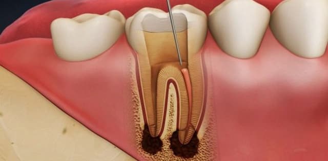 Điều trị tuỷ răng cho bé có nguy hiểm không?